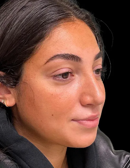 Woman patient after Rhinoplasty treatment, oblique view