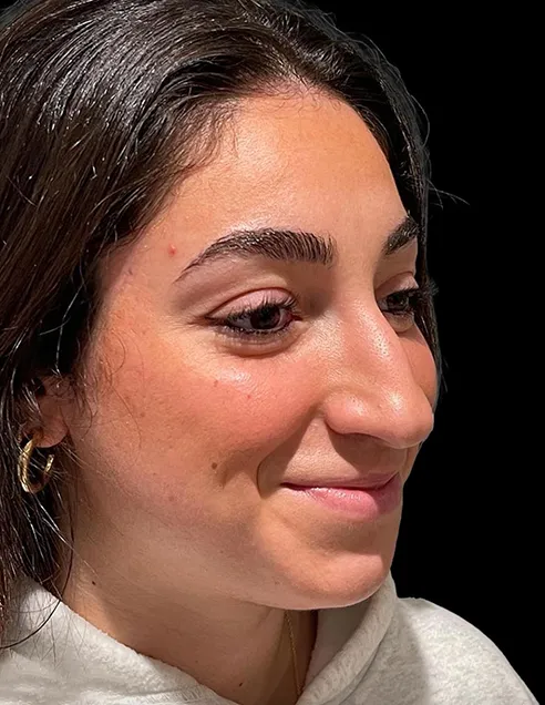 Woman patient before Rhinoplasty treatment, oblique view